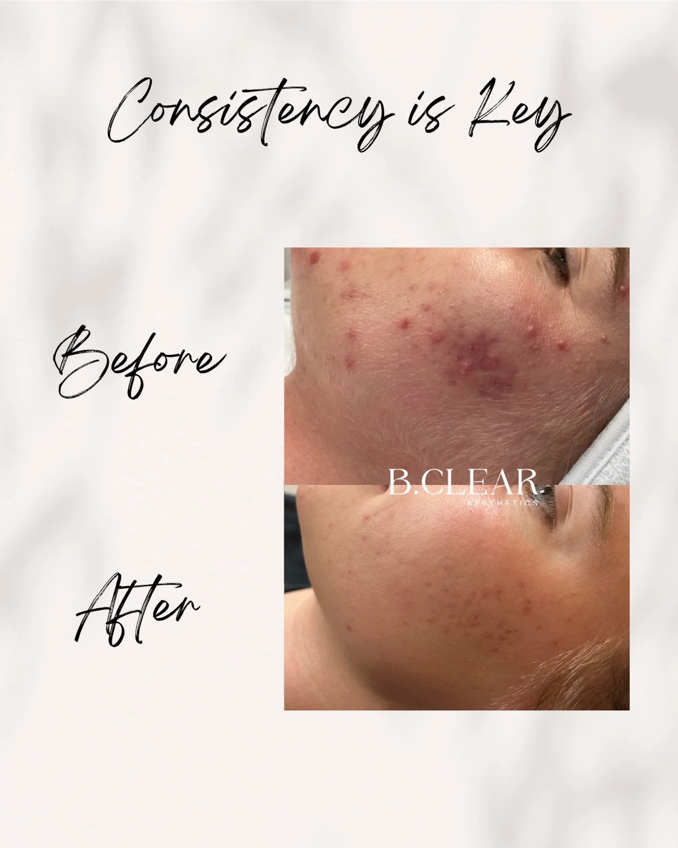 Progress takes patience but the results are worth it ✨

Ready to feel confident in your skin? Start your acne-clearing journey with us and receive:

&bull; Expert guidance from certified Acne Specialists
&bull; A fully personalized treatment plan
&bu