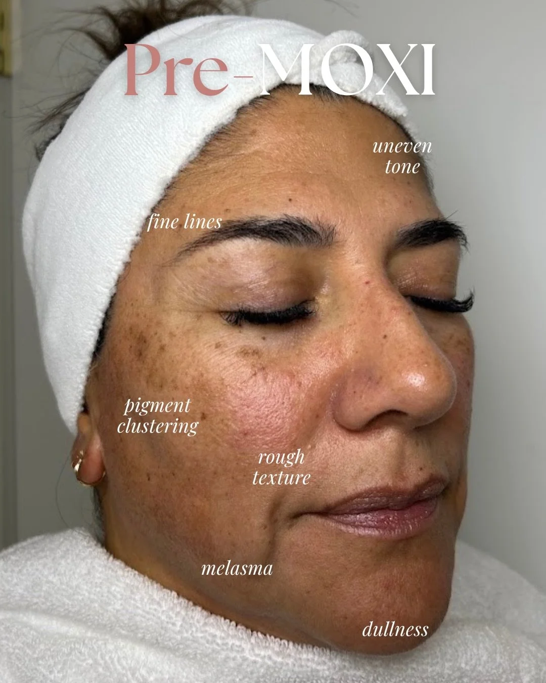 Giving you subtle, but significant ✨ 

With MOXI, you&rsquo;ll notice it in the details&hellip;
&bull;smoother texture
&bull;more even tone
&bull;healthy brightness that makes skin look naturally refreshed 🪄 

This is only after 1 treatment, and the