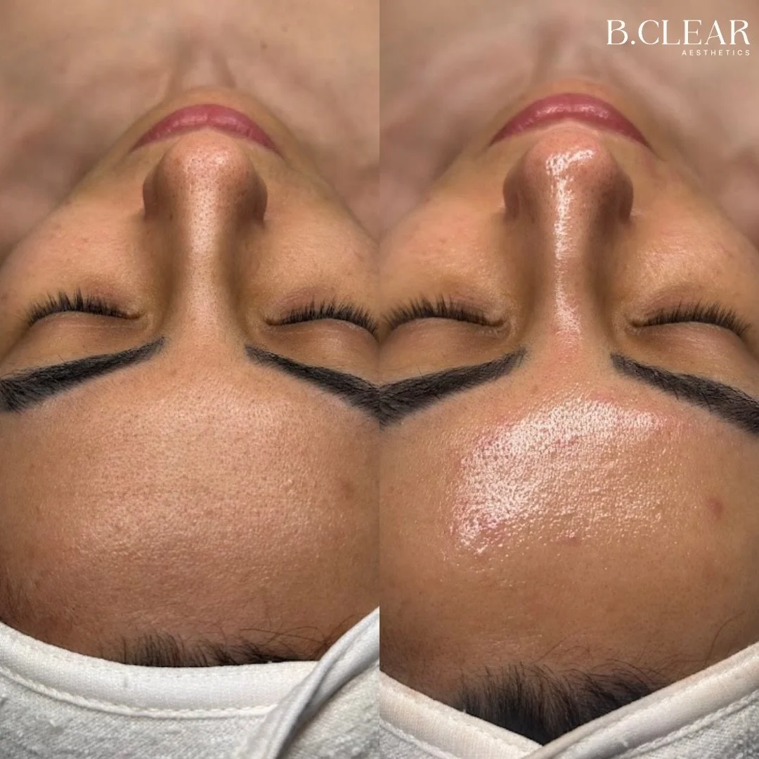 DiamondGlow done with INTENTION 💎

If you&rsquo;ve had one before and thought &ldquo;that was nice&rdquo;&hellip;
this is different. 

We go deeper. More intentional. More customized.

✔ Barrier-supportive exfoliation
✔ Real extractions
✔ Targe