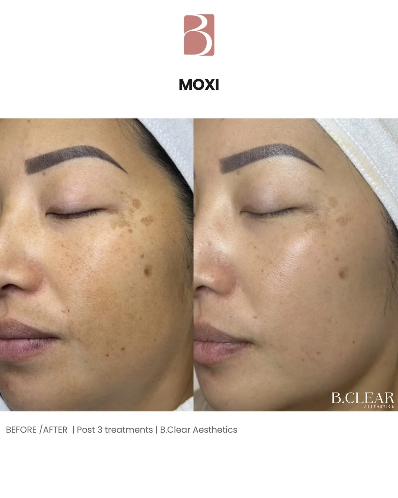 Up close Before and After MOXI ✨🔥 

Our client wanted to focus on her melasma, pigmentation, and overall tone. We were able to target her concerns and achieve this polished result from 3-sessions and a customized homecare routine! 

MOXI is a gentle