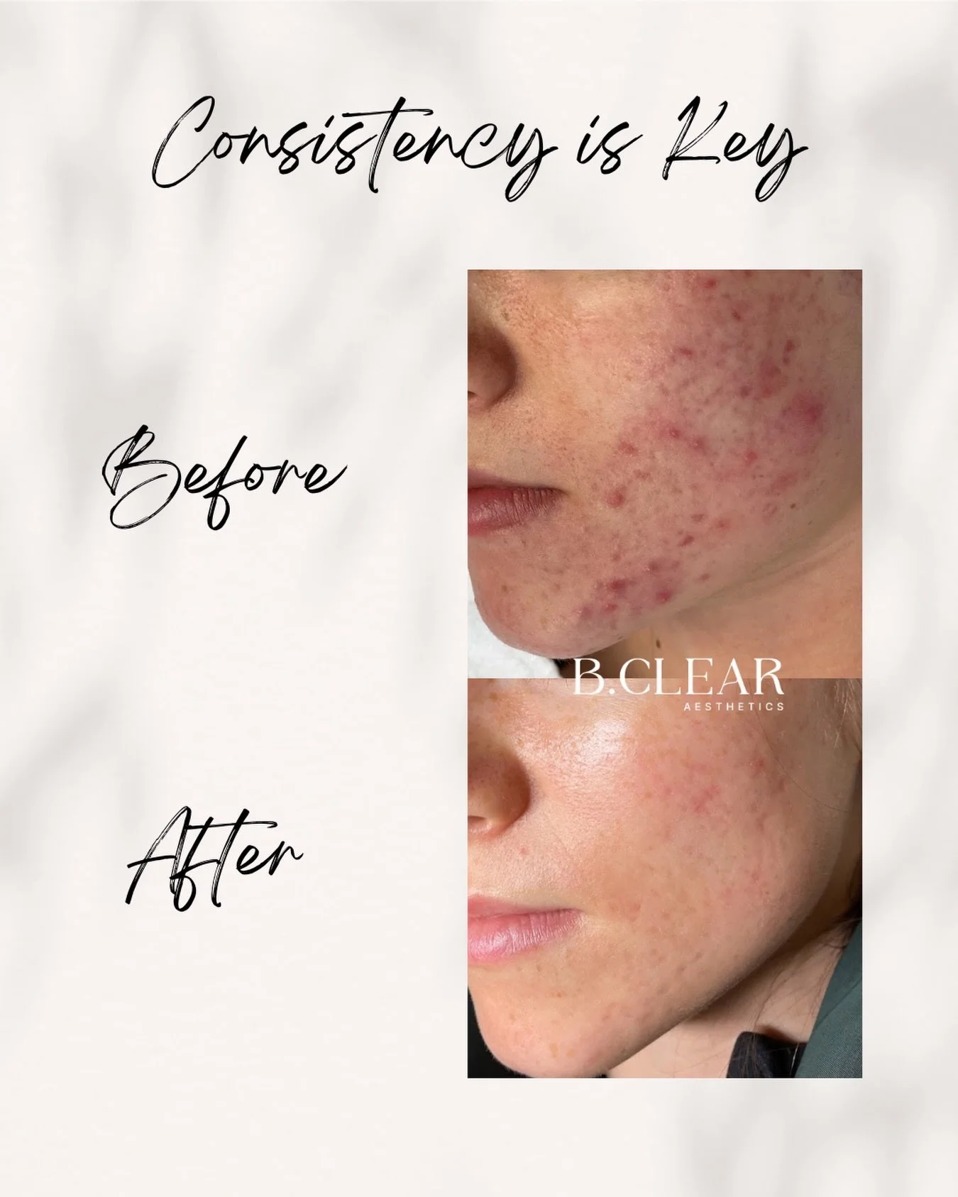 Healthy, clear skin is achievable without prescription medications ✨ 

Our Acne Program is specifically designed to target your skin&rsquo;s individual needs.

We combine treatments, personalized home care, and expert guidance to deliver real and las