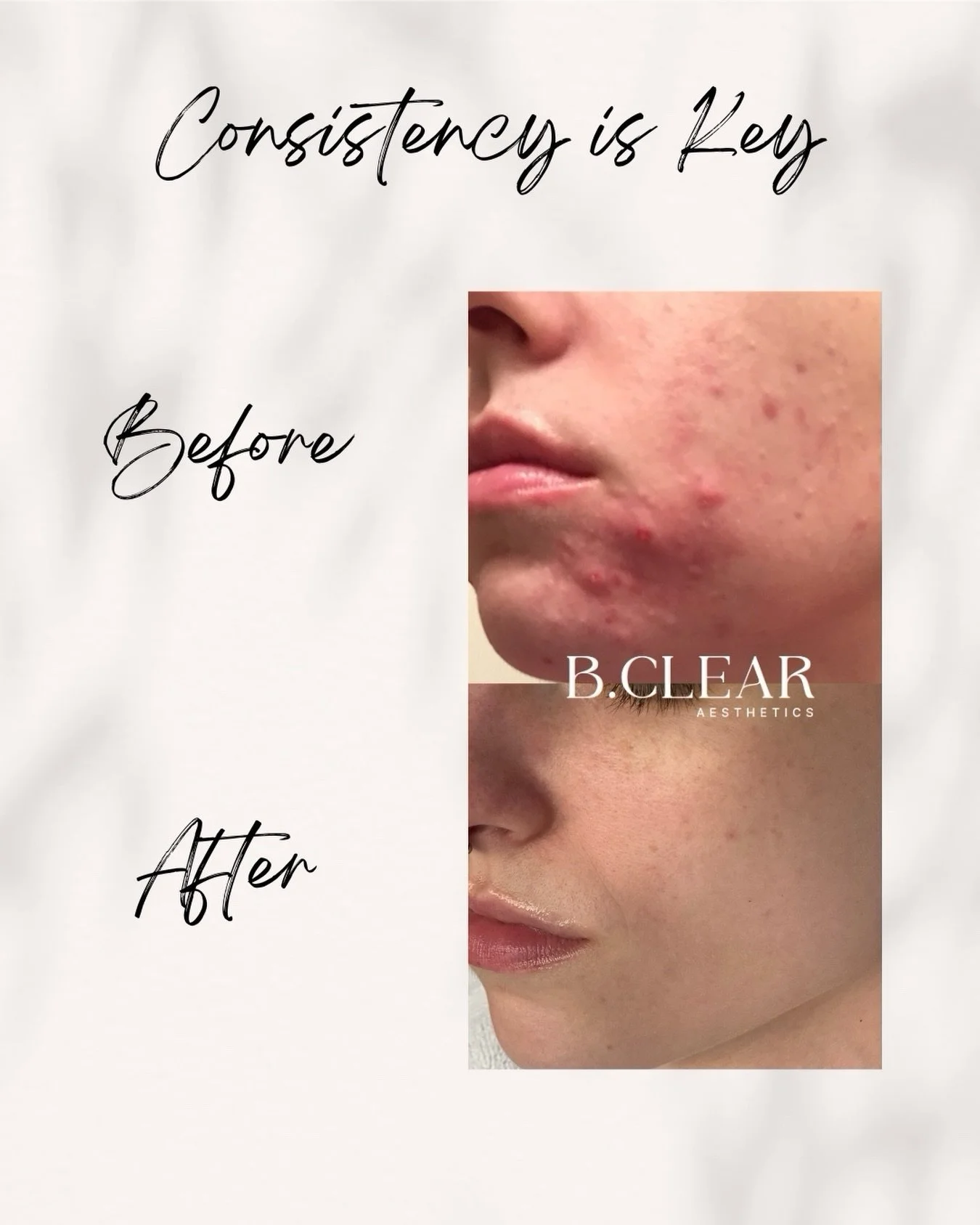 Clearer skin starts with understanding your skin. 

At B.Clear, we know that treating acne isn&rsquo;t a one-size-fits-all process. Every person&rsquo;s skin is different, which is why we focus on understanding what&rsquo;s happening with your skin a