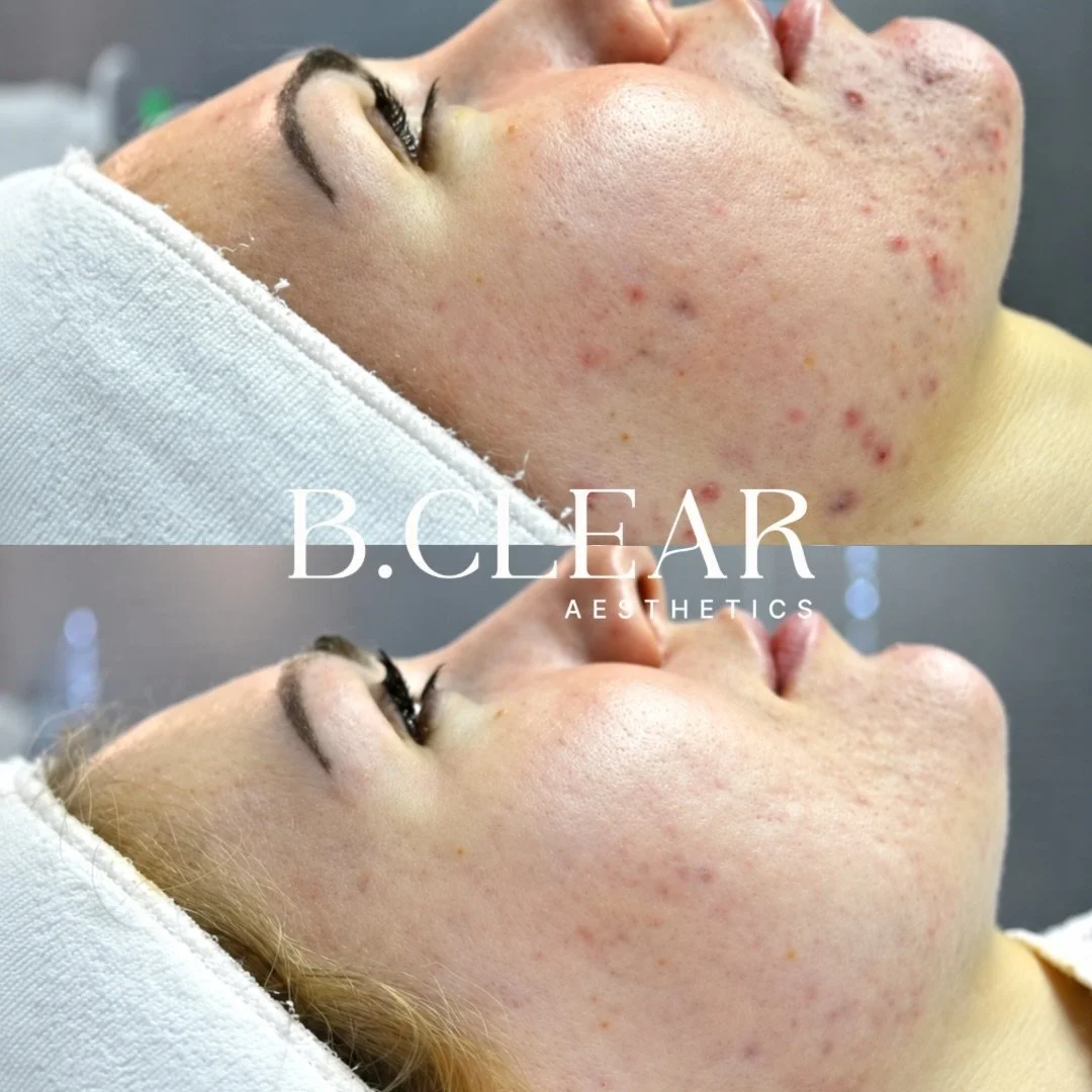 This before and after is a little encouragement to keep going, and a reminder that you don&rsquo;t have to figure it all out on your own. 

Our Acne Program starts with getting to know you:
Your skin. Your routine. And what you&rsquo;ve already tried