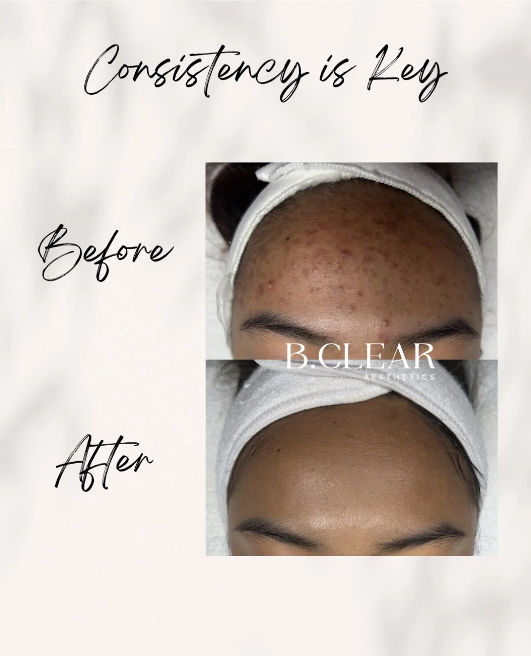 We&rsquo;re so proud of our sweet client and the progress that&rsquo;s been achieved! 🤍

Over the past year she&rsquo;s stayed consistent with monthly acne treatments, at-home skincare routine, and supportive lifestyle changes. Now that she is clear
