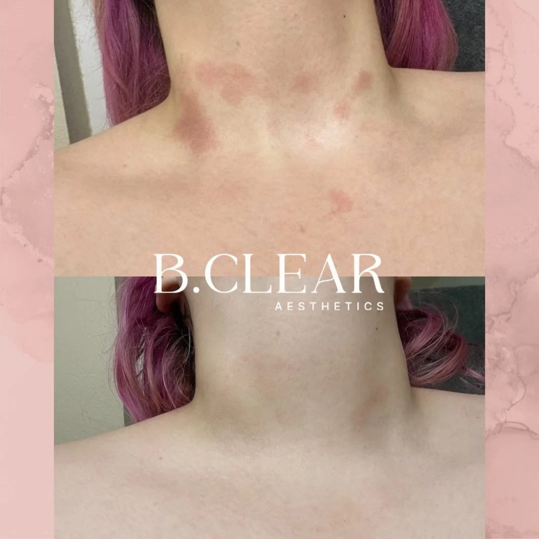 Visible improvement in JUST 48 hours❕⏰

This eczema flare-up subsided within two days of introducing SIV Biome Balancing Serum into the skincare routine. These before-and-after photos documented her progress.

SIV Biome Balancing Serum is a microbiom