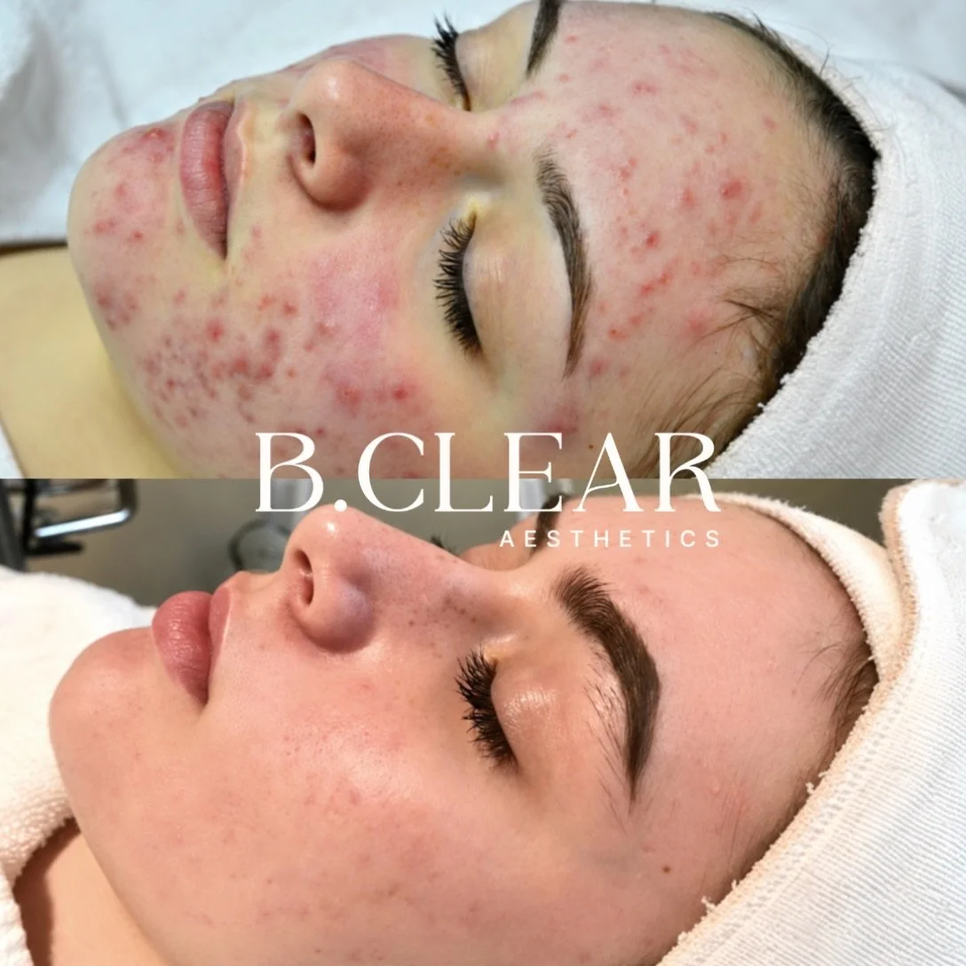 With a customized at-home skincare routine, professional guidance, and consistent commitment, our client achieved these results through our Acne Program.

Let us take the guesswork out of treating your acne with a personalized plan for your unique sk