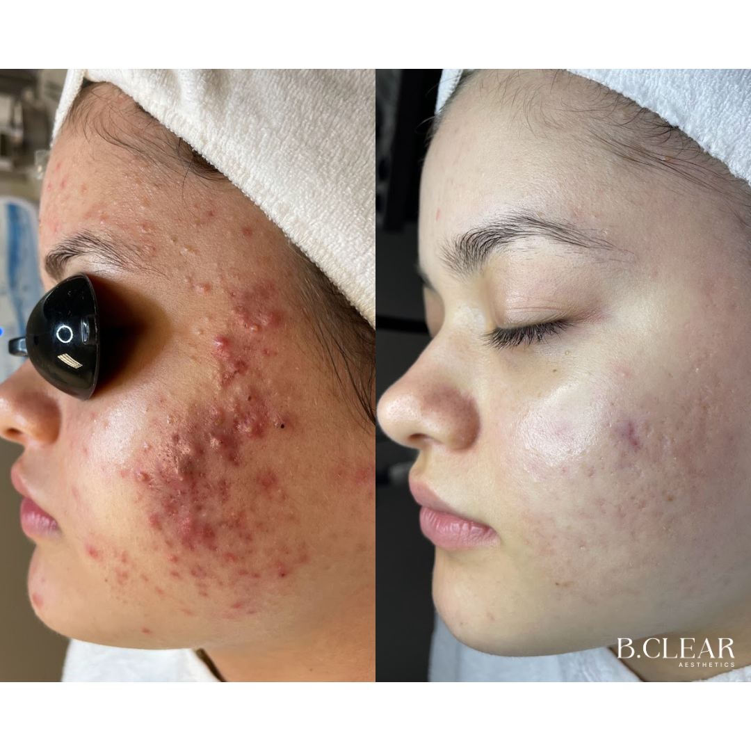 Acne Program Before & After
