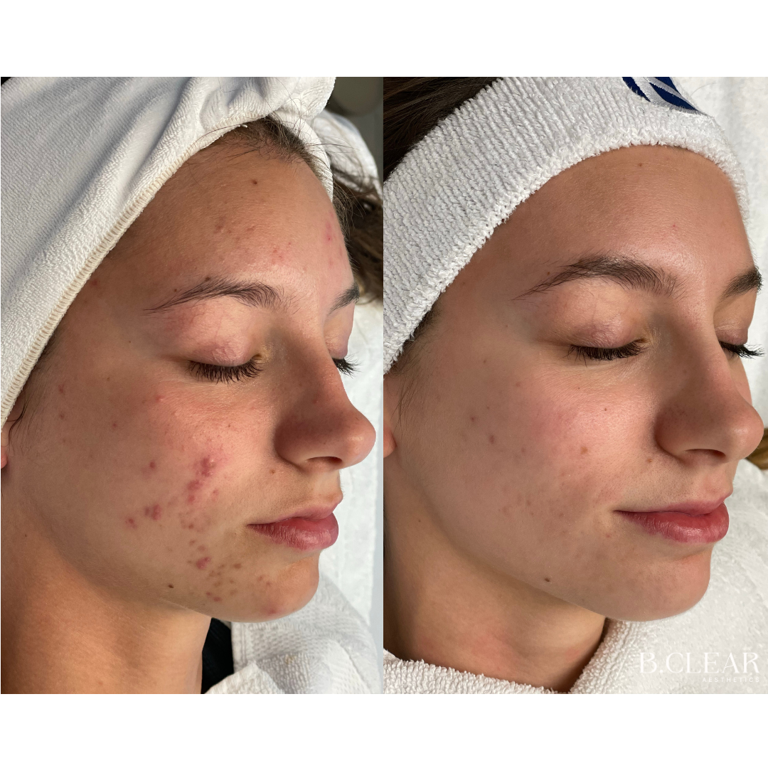 Acne Program Before & After