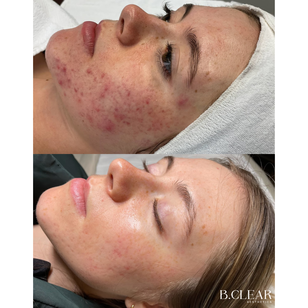 Acne program Before & After