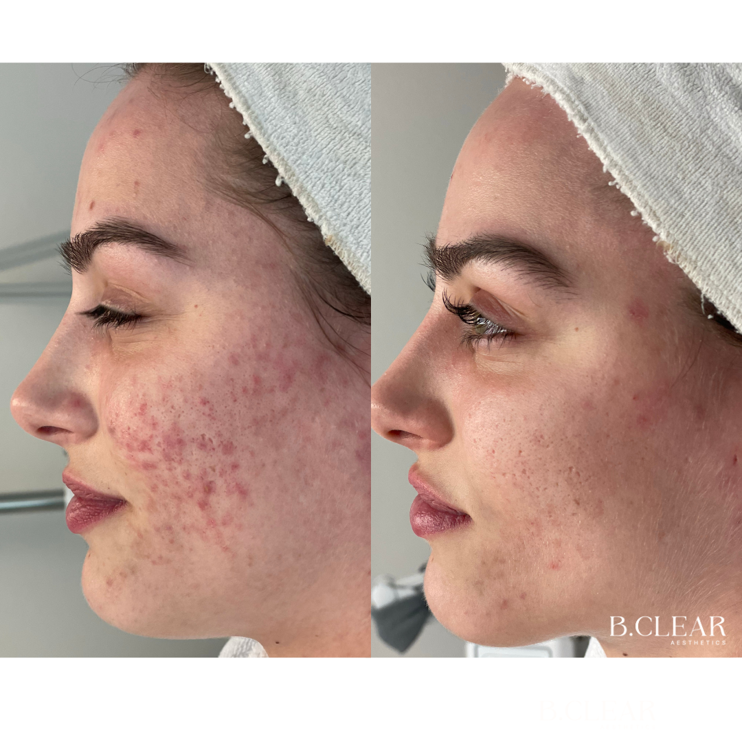 Acne Program Before & After