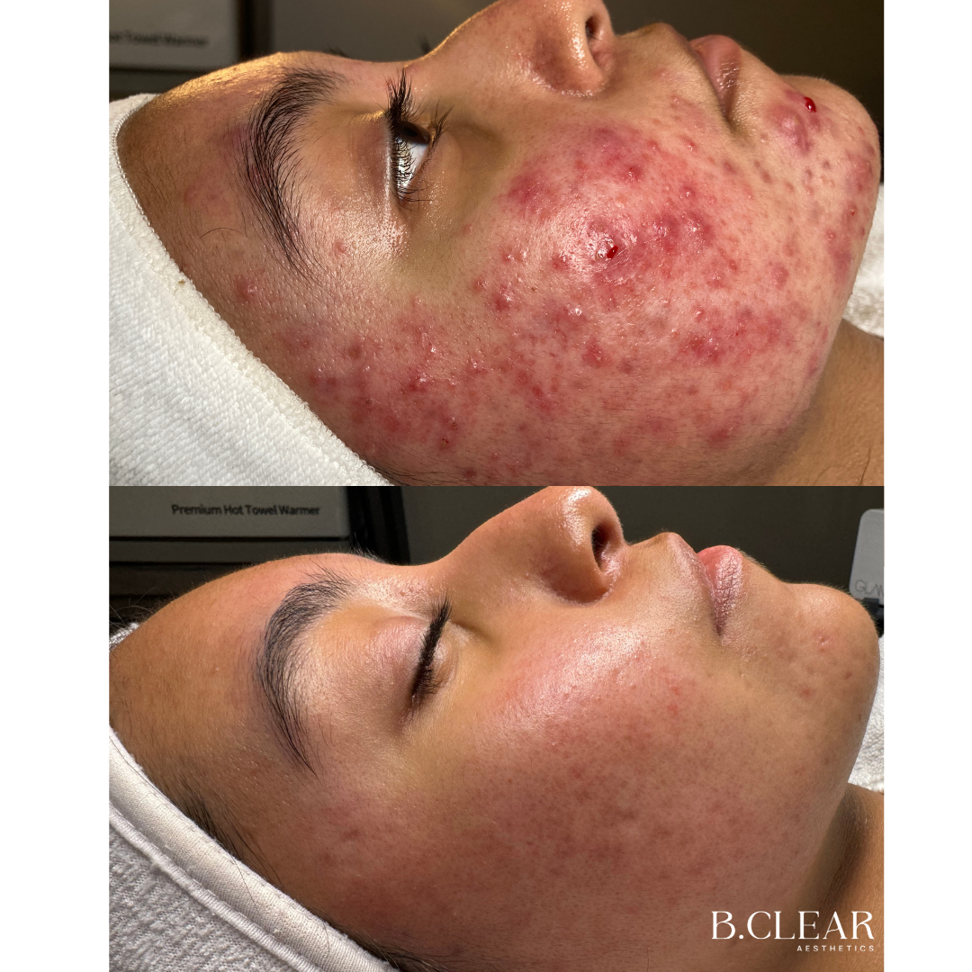 Acne Program Before & After
