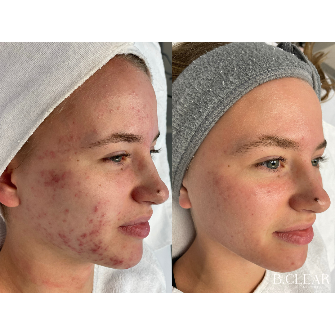 Acne Program Before & After