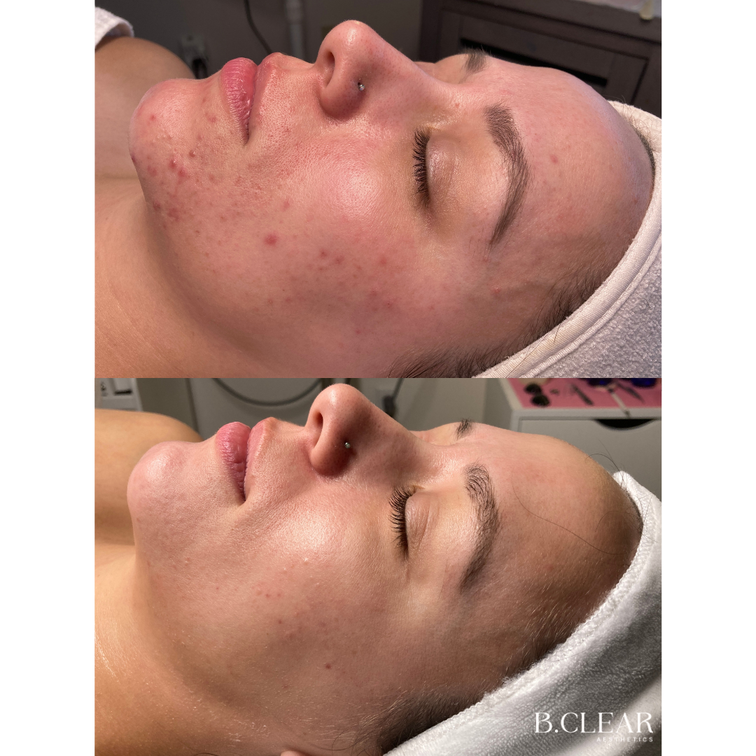 Acne Program Before & After