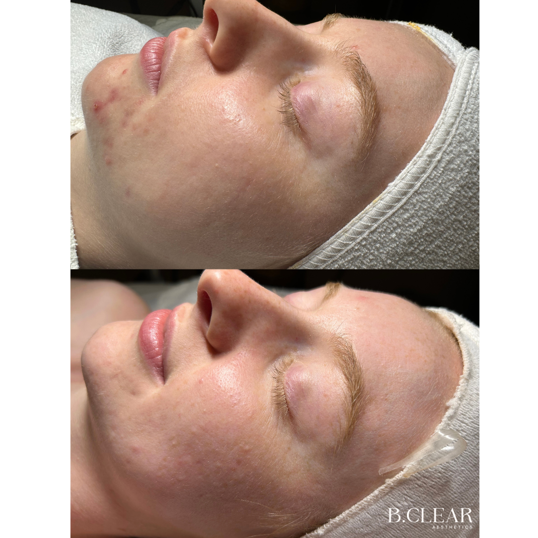 Acne Program Before & After