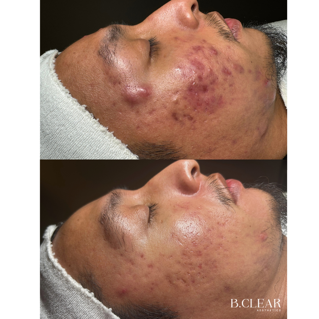 Acne Program Before & After