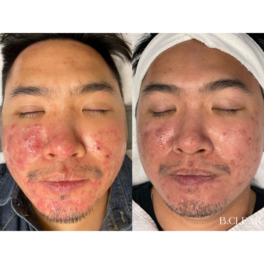 Acne Program Before & After
