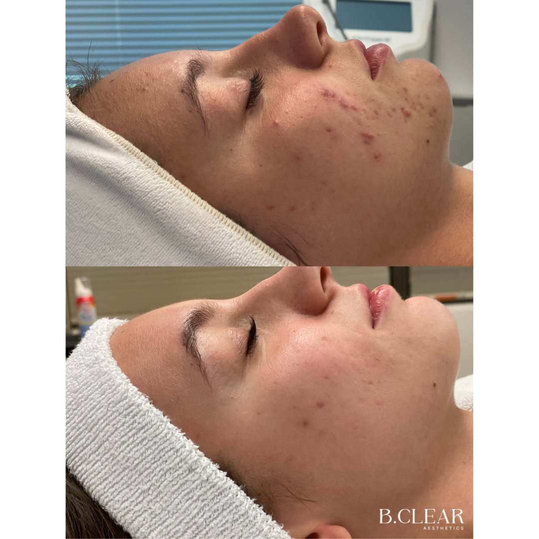 Acne Program Before & After