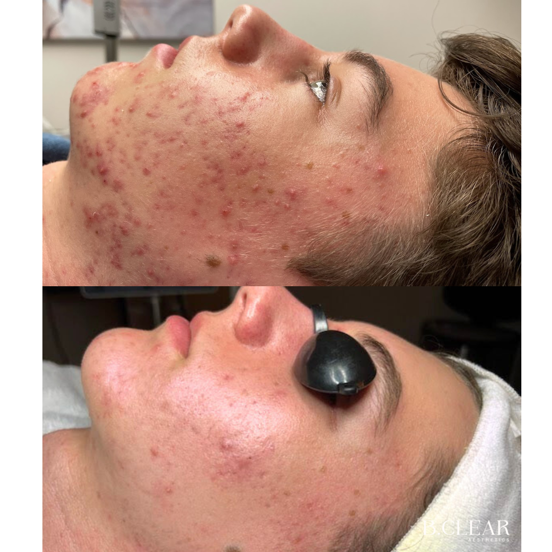 Acne Program Before & After