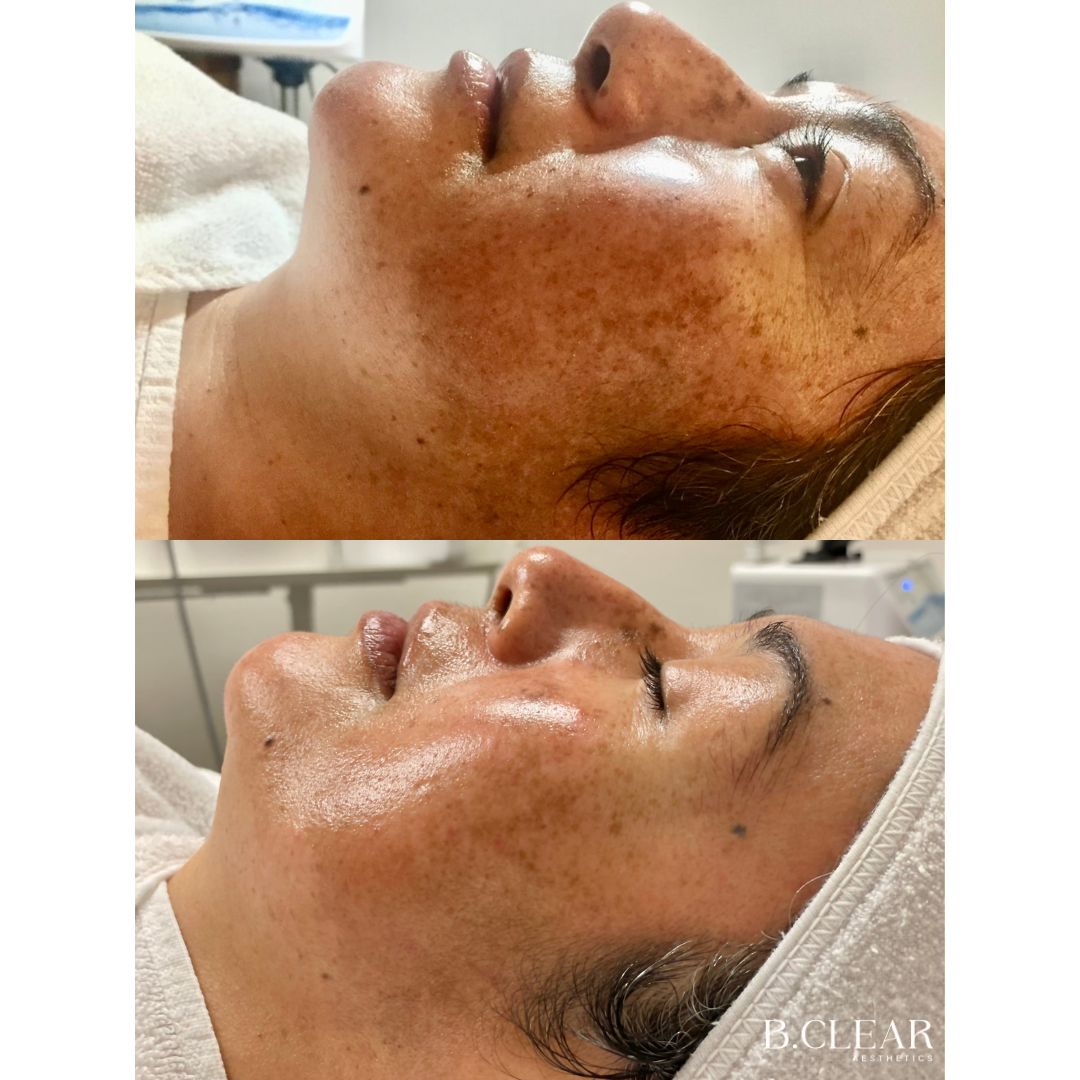 Chemical peels Before & After