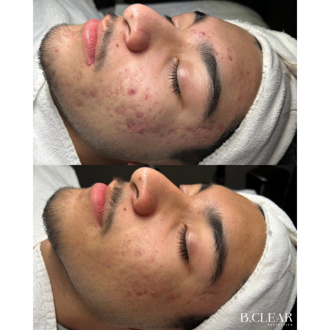Acne Program Before & After