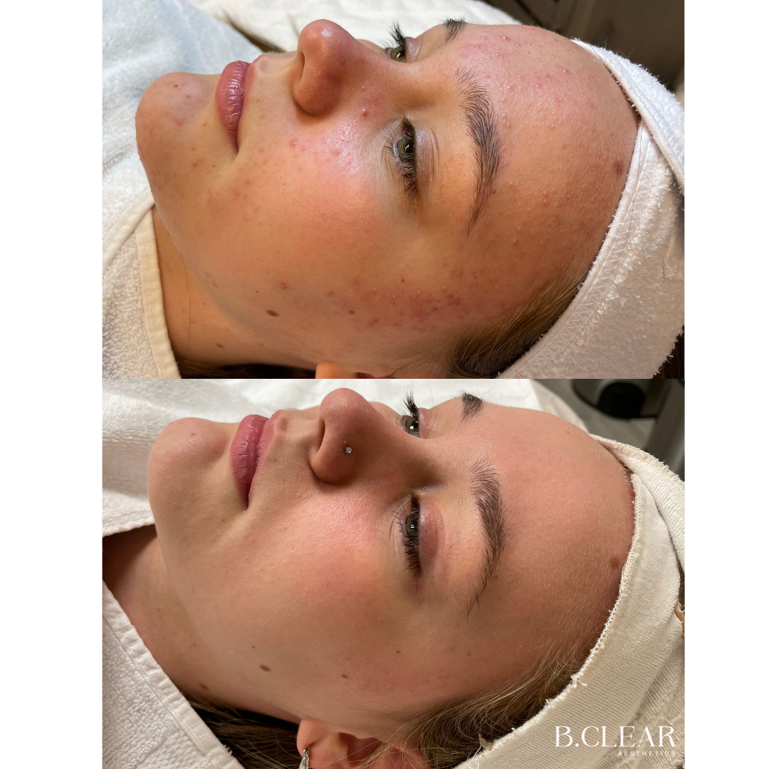 Acne Program Before & After