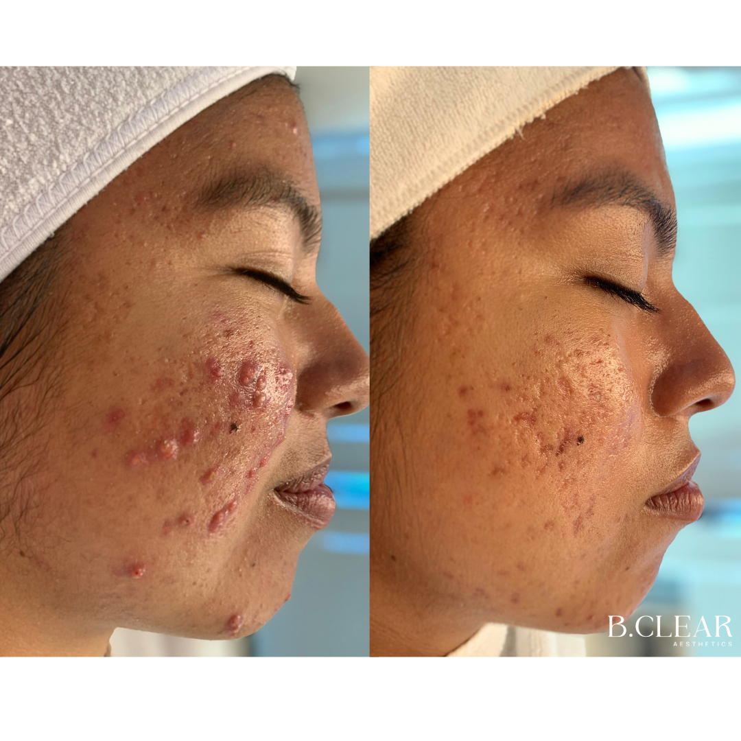 Acne Program Before & After