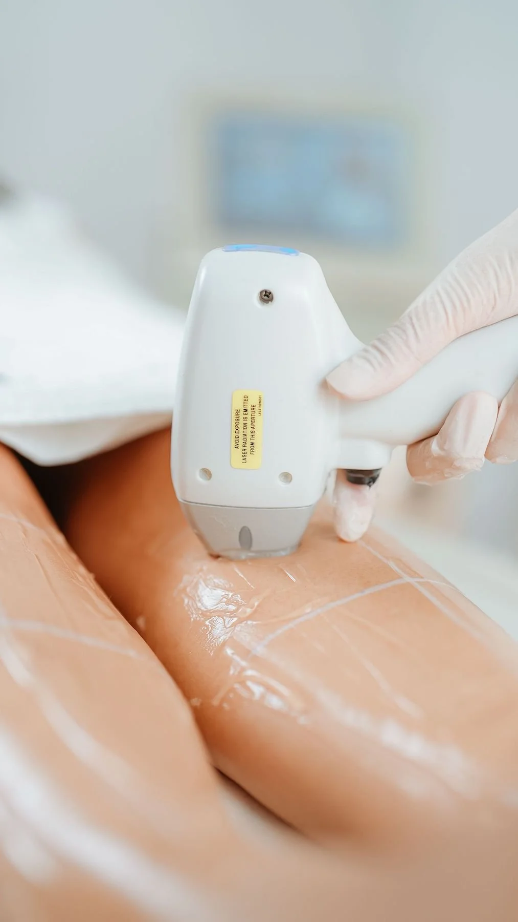 laser hair removal beaverton
