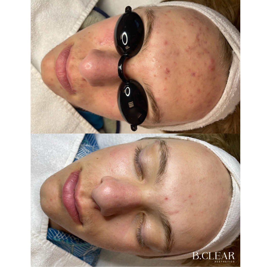 Acne Program Before & After