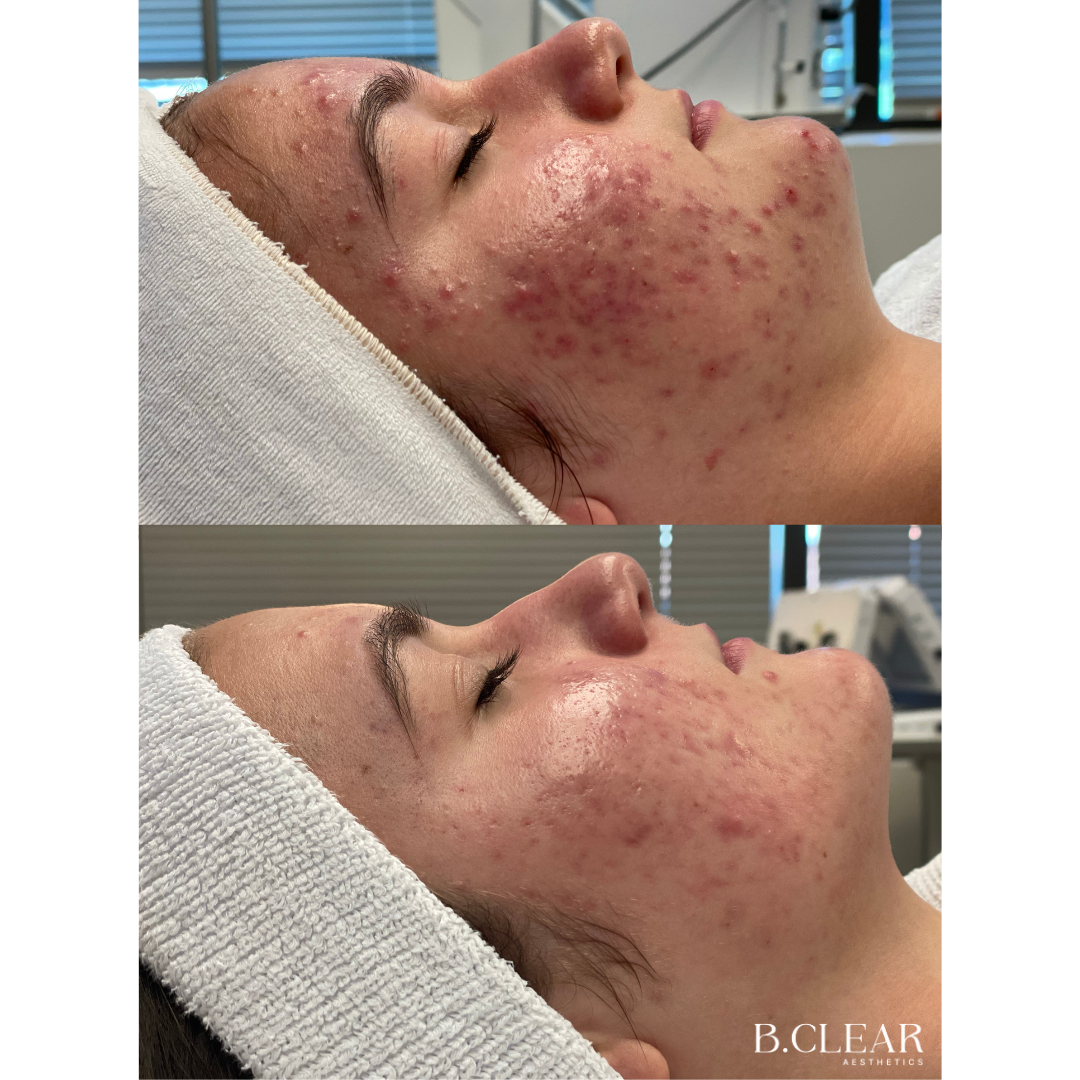 Acne Program Before & After