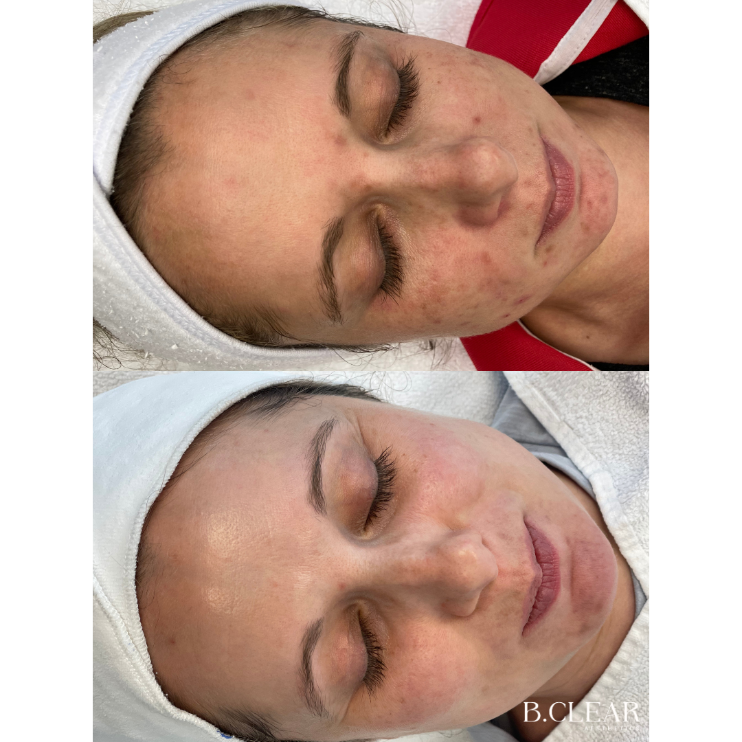 Acne Program Before & After