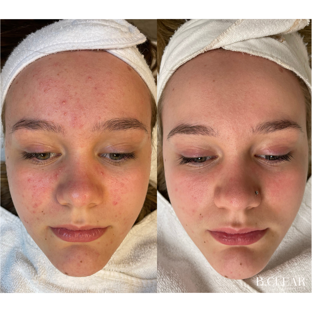 Acne Program Before & After