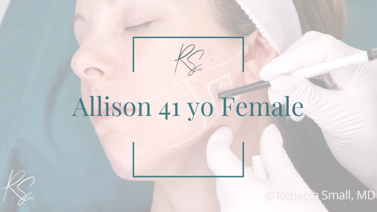 A woman receiving a cosmetic or medical treatment on her face from a healthcare professional wearing white gloves. The woman's eyes are closed, and there is a marking on her cheek. Text overlays the image, reading 'Allison 41 yo Female,' with a logo in the top left corner.