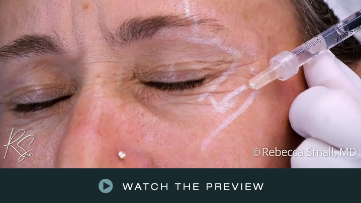 Close-up of a person receiving a cosmetic injection near the eye area from a medical professional wearing white gloves.