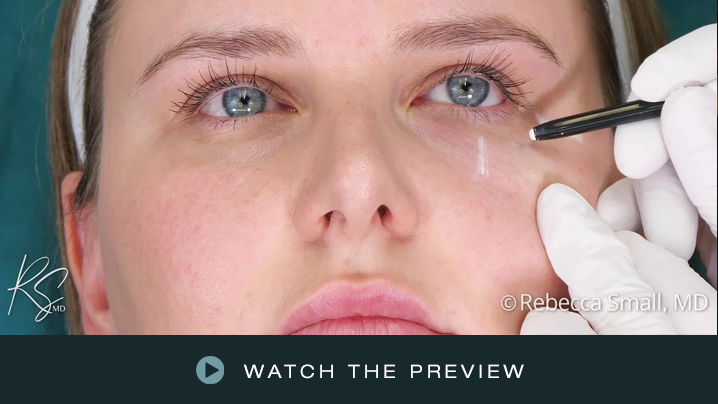 Close-up of a woman receiving a cosmetic procedure on her under-eye area with a medical professional using a small tool.