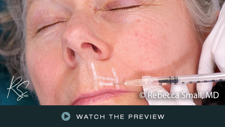 Close-up of an elderly woman receiving a cosmetic injection around her lips, with a visible syringe and markings on her face for treatment guide.