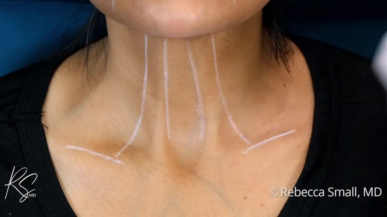 Medical markings on a woman's neck indicating planned surgical incision sites.