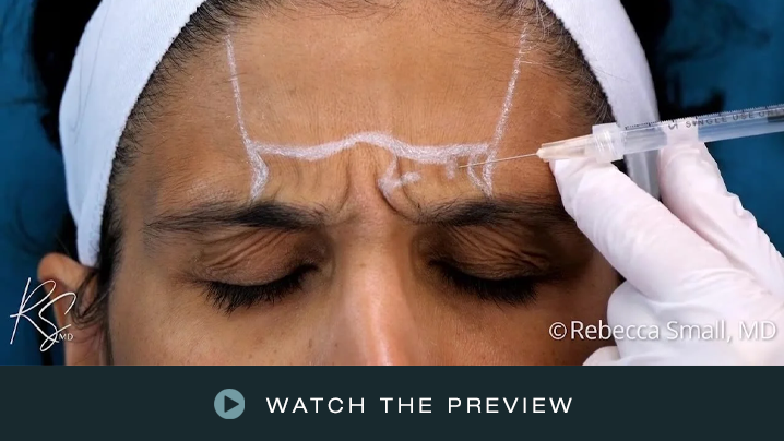 Medical professional administering Botox injection to a woman's forehead with markings around her eyebrows.