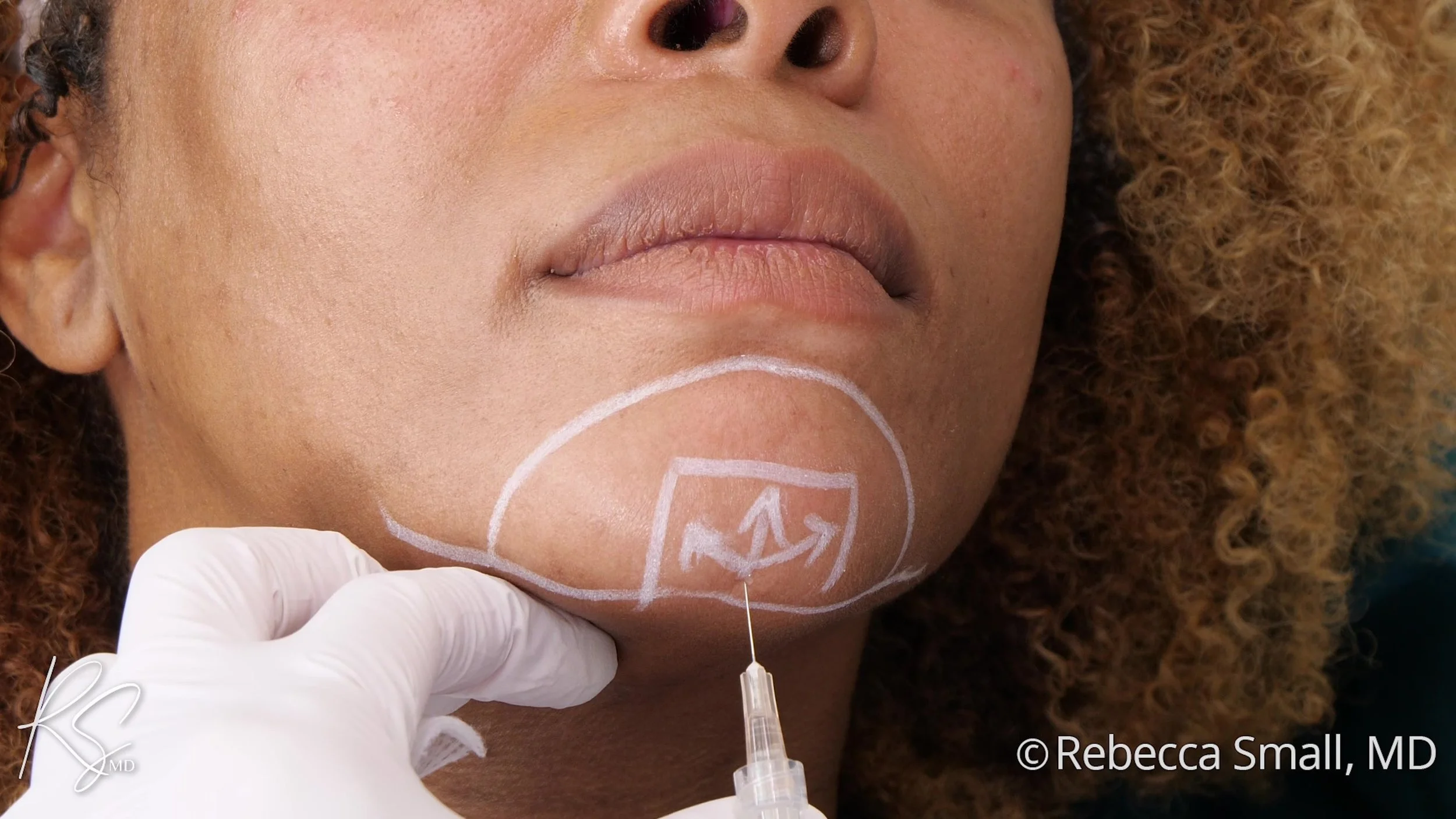 Close-up of a woman's face with face markings, receiving a cosmetic injection under her chin, with a healthcare professional wearing gloves administering the treatment.