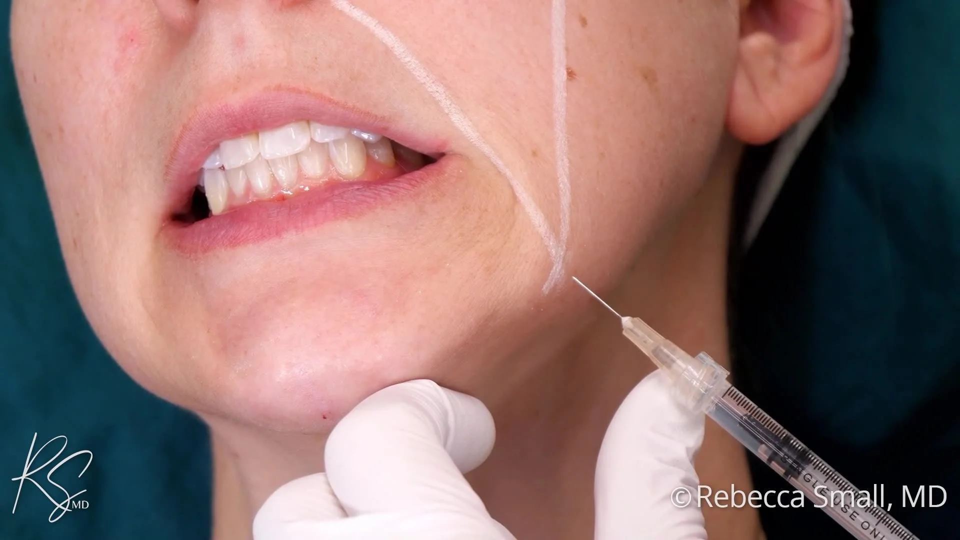 A close-up of a person receiving a cosmetic injection on their cheek, with a healthcare professional wearing white gloves administering the injection using a syringe.