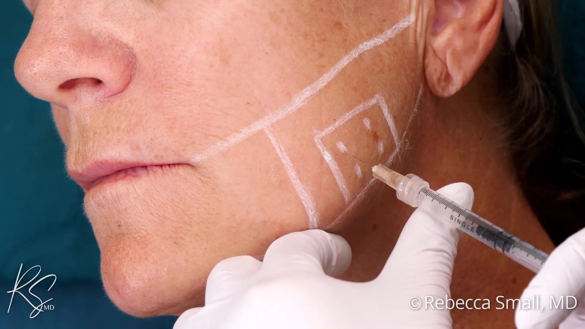 Close-up of a woman receiving a facial injection with a syringe, with markings on her face indicating treatment areas.