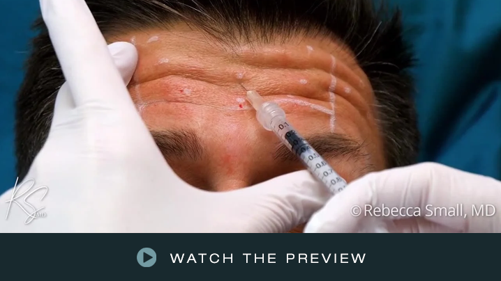 A medical professional administers an injection to a person's forehead, which has visible wrinkles and small bumps, using a syringe. The professional is wearing white gloves.