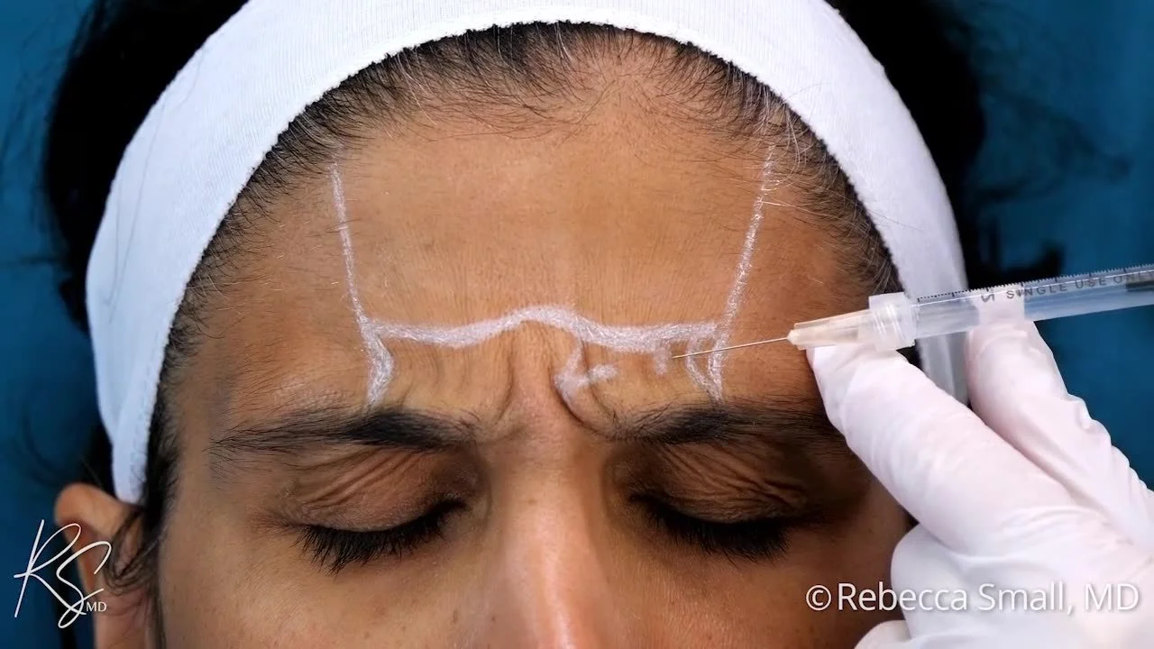 Dr. Small injects botulinum toxin for treatment of frown lines