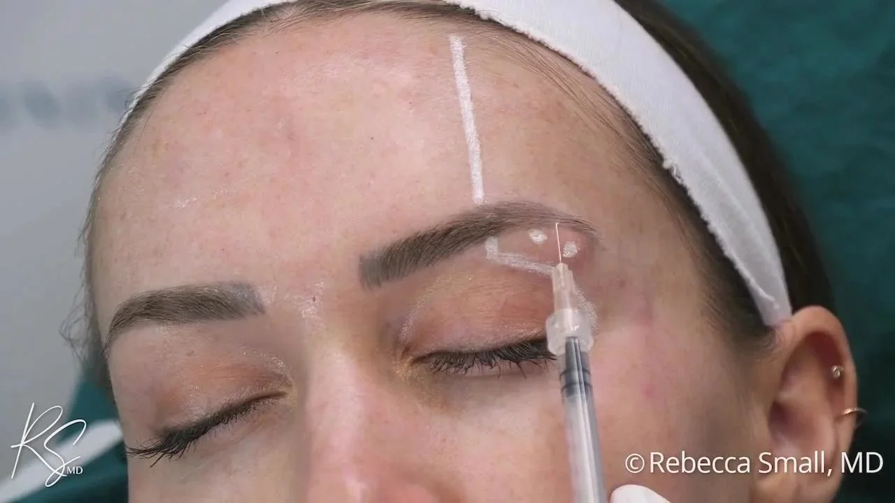 A woman receiving a cosmetic injectable treatment in her eyebrow area with a syringe, lying down with her eyes closed, wearing a headband.