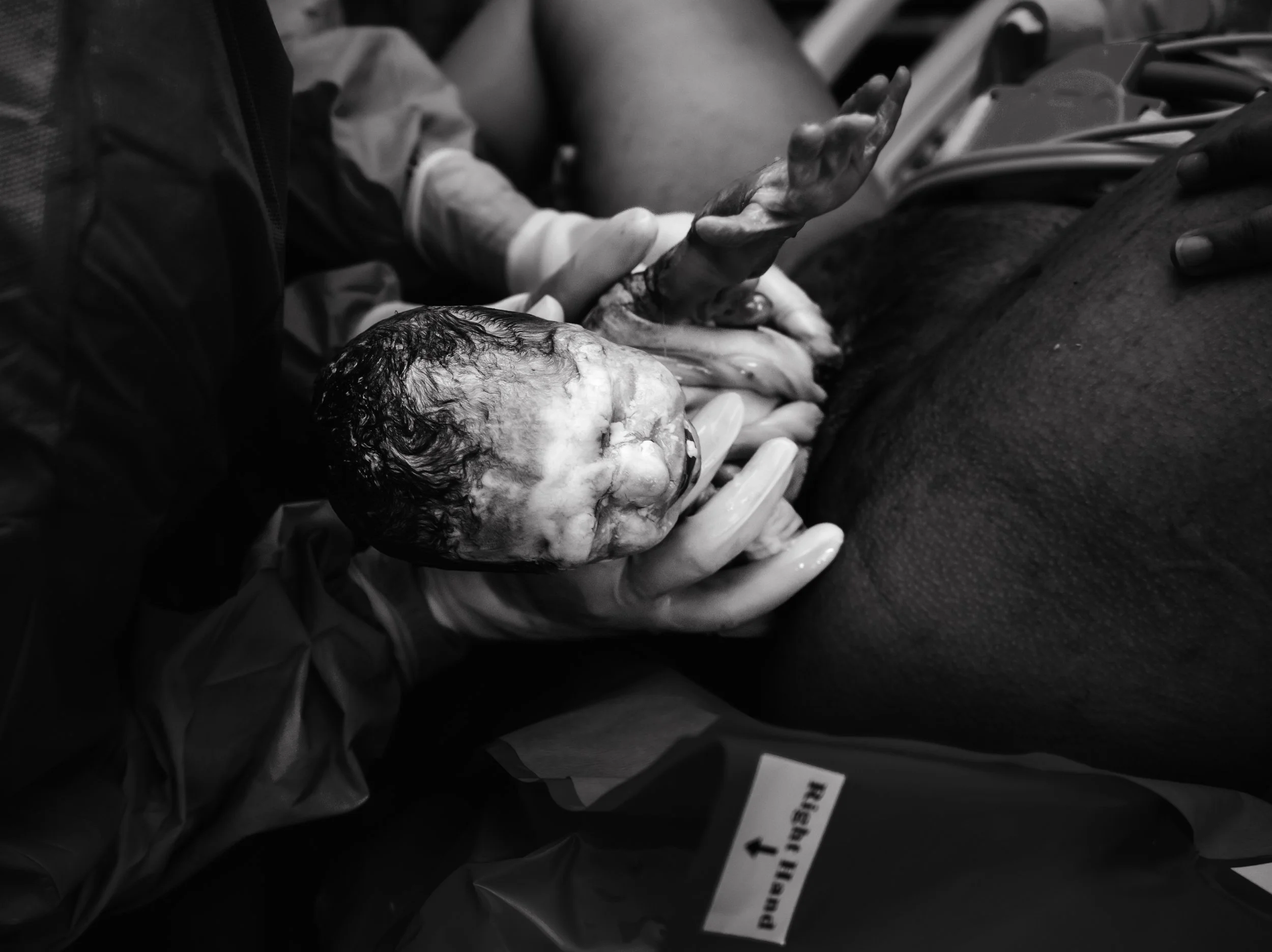 Black and white photo of a newborn baby being held by medical staff during delivery. The baby's head and face are visible, and the baby is covered in vernix caseosa. One of the staff's gloved hands supports the baby's head while another holds the bab