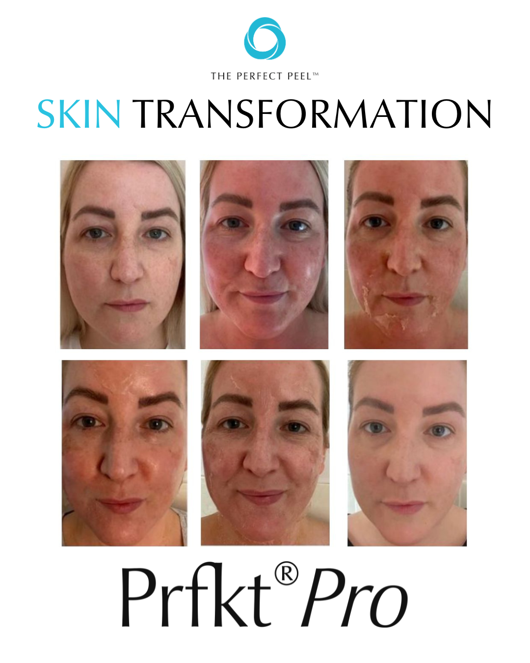 Six before-and-after photos showing skin transformation using Prfkt Pro, with a logo and text labeled 'The Perfect Peel' and 'Skin Transformation' at the top.