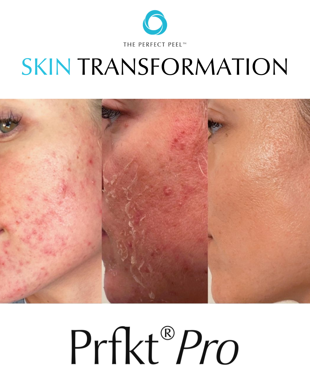 Advertisement showing before and after images of skin improvement with the product Prfkt Pro, focusing on clear skin transformation.