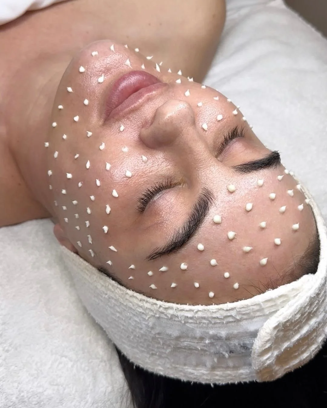 cellstory liquid microneedling