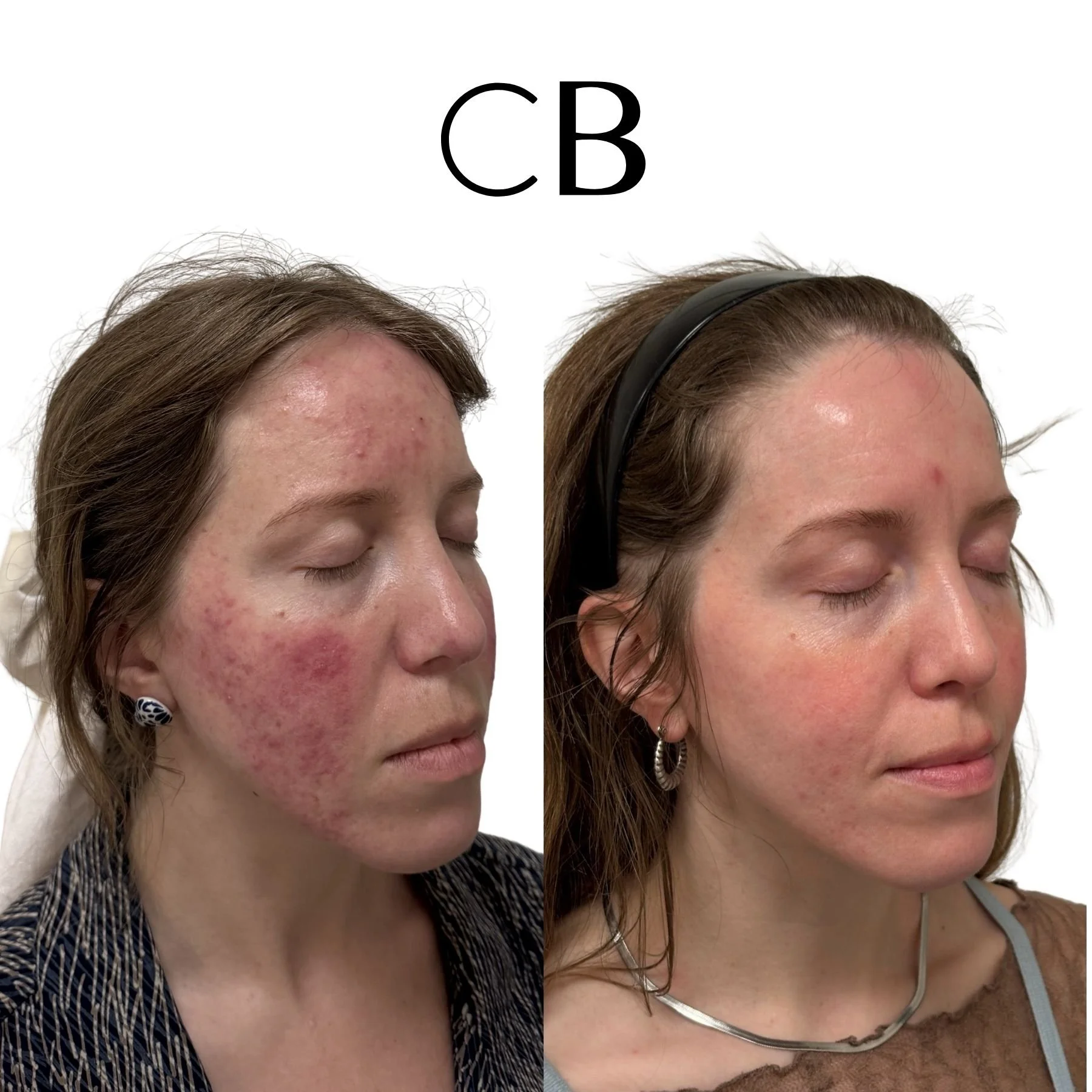 Real Patient Results: How We Help Clear Stubborn Acne