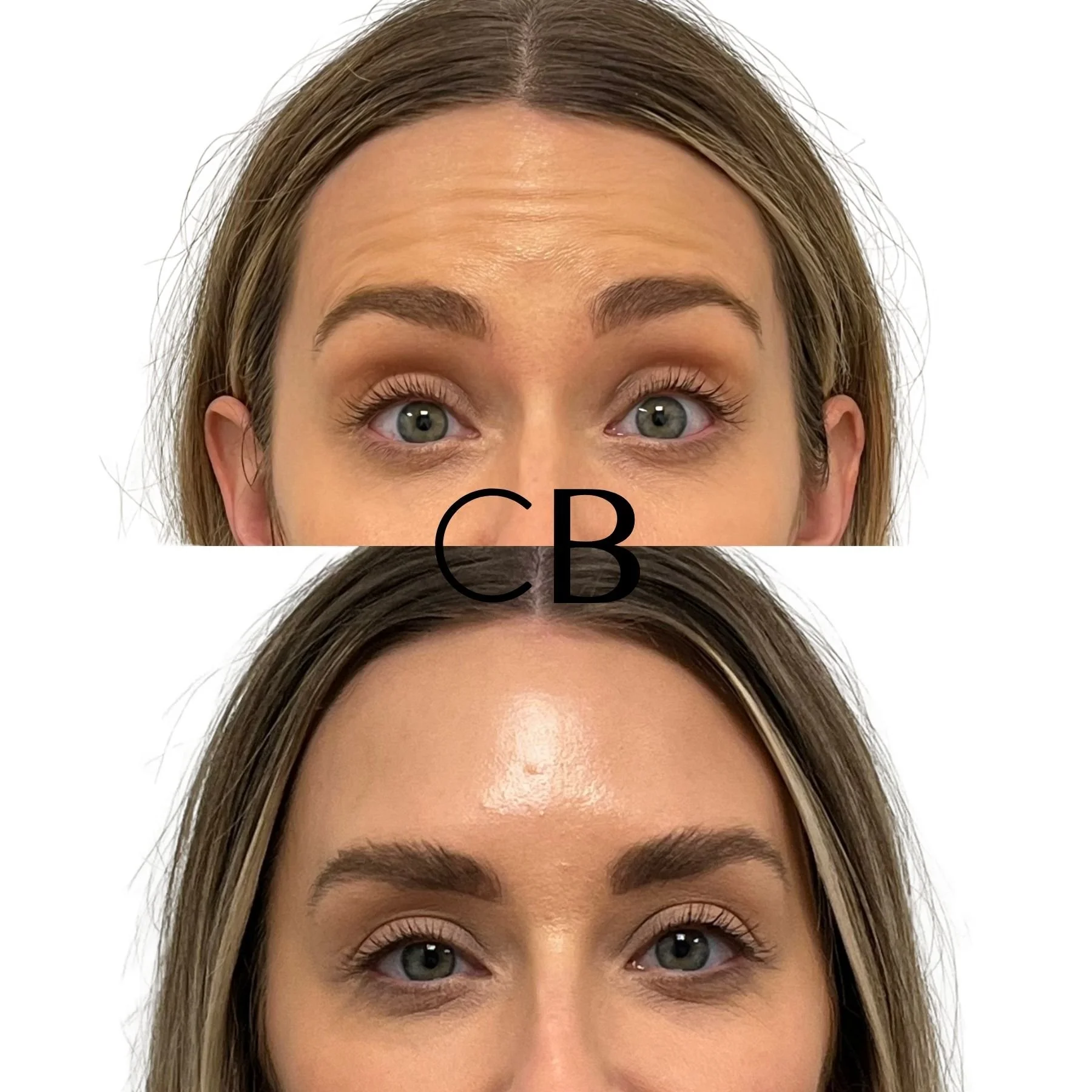 Botox before and after Spokane WA