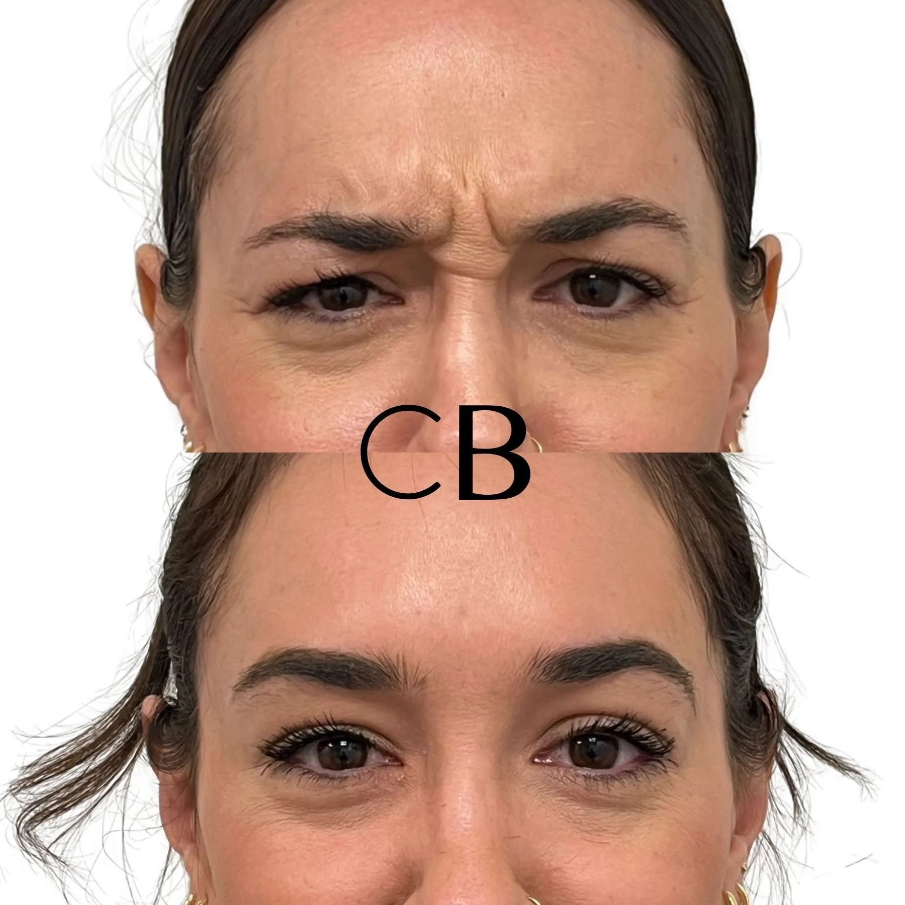 Botox Before and After